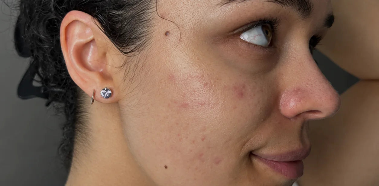 Skin appearance, after